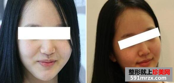 下巴矫正整形效果图+注射瘦脸案例分享