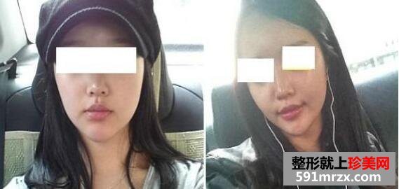 下巴矫正整形效果图+注射瘦脸案例分享