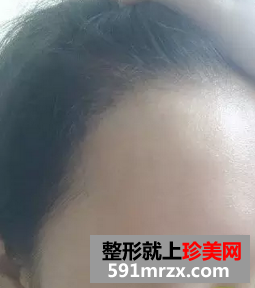 种植头发前后效果展示 种植头发案例分享