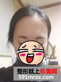 种植头发前后效果展示 种植头发案例分享