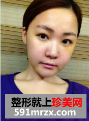 缩下巴整形手术恢复期照片