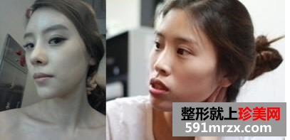 下颚前凸突嘴整形矫正手术真人案例分享