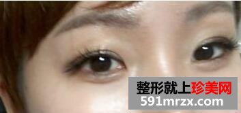 眼部整形开眼角手术真人案例最新发布