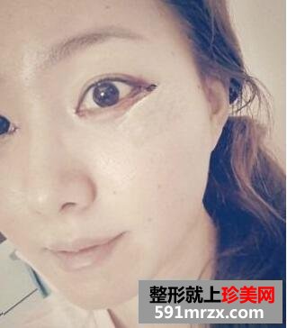 眼部整形开眼角手术真人案例最新发布