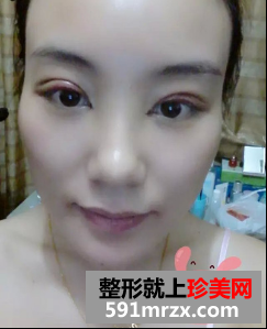 割双眼皮开眼角恢复期经历分享