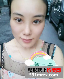 割双眼皮开眼角恢复期经历分享