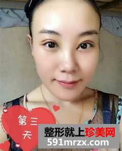 割双眼皮开眼角恢复期经历分享