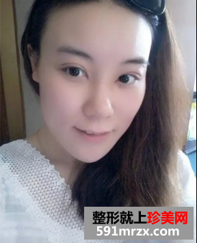 割双眼皮开眼角恢复期经历分享