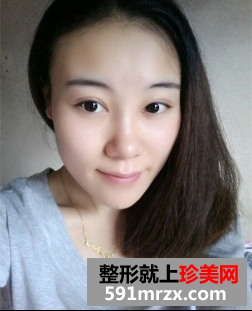 割双眼皮开眼角恢复期经历分享