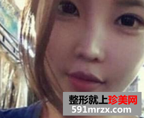 瘦脸针  让我也有了精致可爱的小脸 - 珍美网