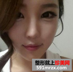 瘦脸针  让我也有了精致可爱的小脸 - 珍美网