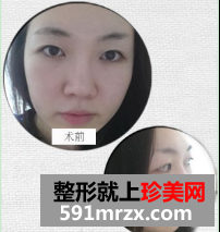 埋线双眼皮修复+鼻部修复历程