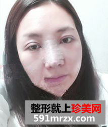 埋线双眼皮修复+鼻部修复历程