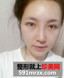 埋线双眼皮修复+鼻部修复历程