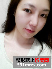 埋线双眼皮修复+鼻部修复历程
