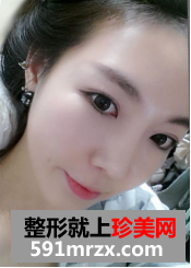 埋线双眼皮修复+鼻部修复历程