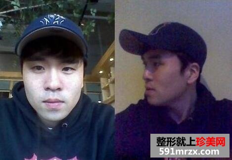 硅胶假体隆鼻面部自体脂肪填充手术真实案例最新版分享