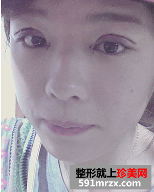 双眼皮前后对比照 内双变外双的完美脱