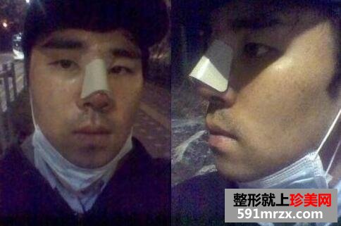 硅胶假体隆鼻面部自体脂肪填充手术真实案例最新版分享