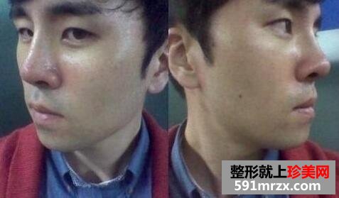 硅胶假体隆鼻面部自体脂肪填充手术真实案例最新版分享
