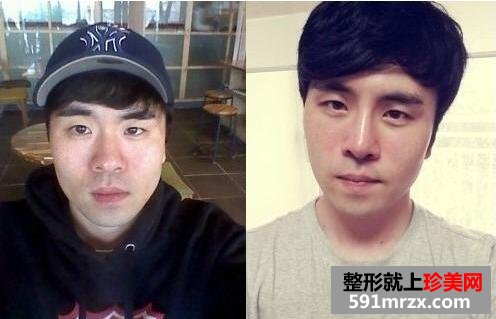 硅胶假体隆鼻面部自体脂肪填充手术真实案例最新版分享