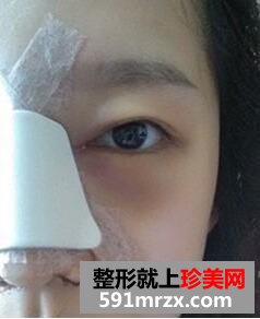硅胶假体隆鼻手术真人案例前后对比照