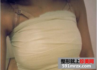 假体隆胸手术术前术后真人案例对比图