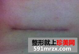 水滴型假体隆胸手术真实恢复全过程对比图