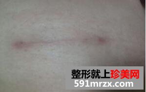 水滴型假体隆胸手术真实恢复全过程对比图