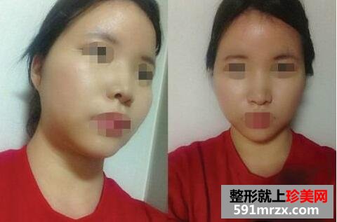 3D回转颧骨硅胶隆鼻整形手术真实案例最新分享