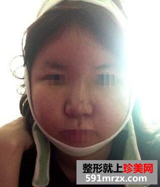 3D回转颧骨硅胶隆鼻整形手术真实案例最新分享