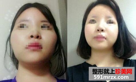 3D回转颧骨硅胶隆鼻整形手术真实案例最新分享