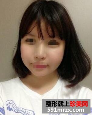 3D回转颧骨硅胶隆鼻整形手术真实案例最新分享