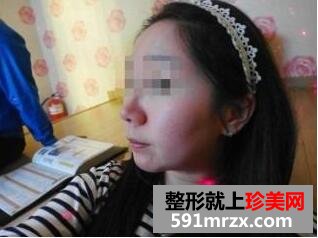 注射法打造鹅蛋脸图片最新案例真人分享