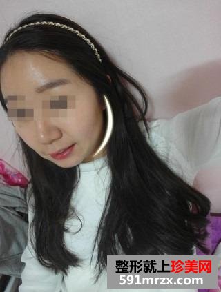注射法打造鹅蛋脸图片最新案例真人分享