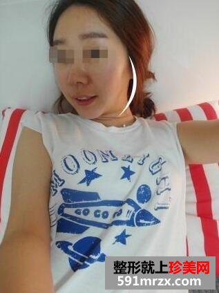 注射法打造鹅蛋脸图片最新案例真人分享