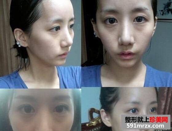 黑眼圈矫正颧骨提高手术最新版真人案例分享