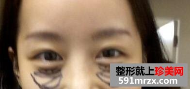黑眼圈矫正颧骨提高手术最新版真人案例分享