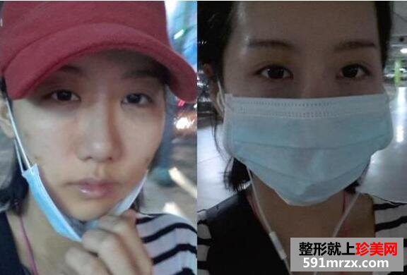 黑眼圈矫正颧骨提高手术最新版真人案例分享