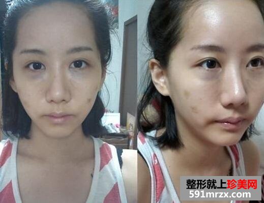 黑眼圈矫正颧骨提高手术最新版真人案例分享
