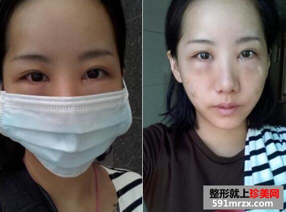 黑眼圈矫正颧骨提高手术最新版真人案例分享