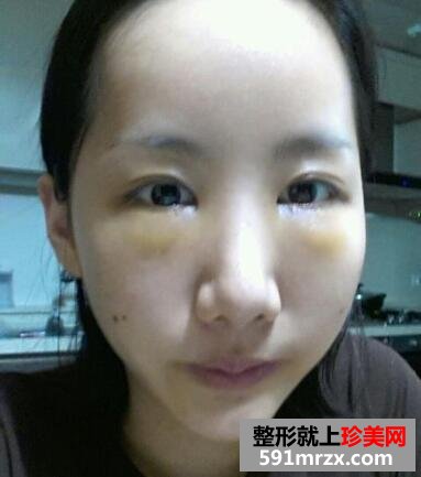 黑眼圈矫正颧骨提高手术最新版真人案例分享