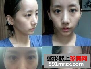 黑眼圈矫正颧骨提高手术最新版真人案例分享