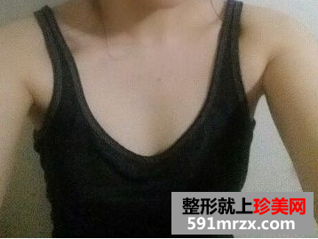 假体隆胸后恢复过程图 假体隆胸整形前后对比