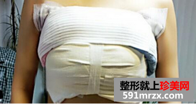 假体隆胸后恢复过程图 假体隆胸整形前后对比