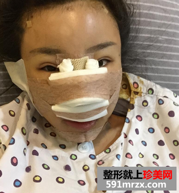 隆鼻+隆下巴手术真实案例