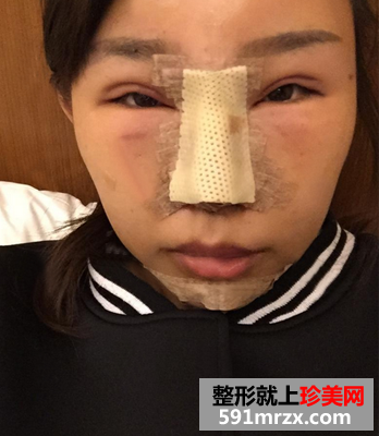 隆鼻+隆下巴手术真实案例
