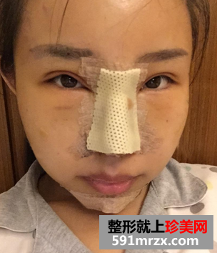 隆鼻+隆下巴手术真实案例
