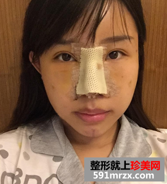 隆鼻+隆下巴手术真实案例