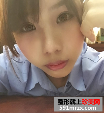 隆鼻+隆下巴手术真实案例